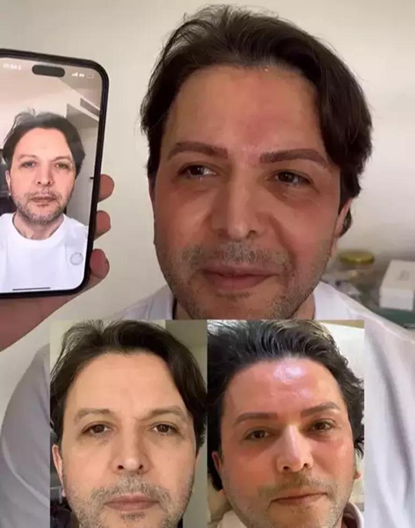 Nihat Doğan da estetikli furyasına katıldı! İşte son hali