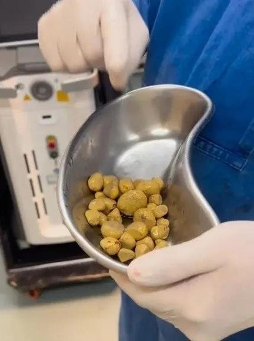 Belirtisi kötü oldu! Günde 3 litre kola içenin böbreklerin çıkanlara kimse inanamadı
