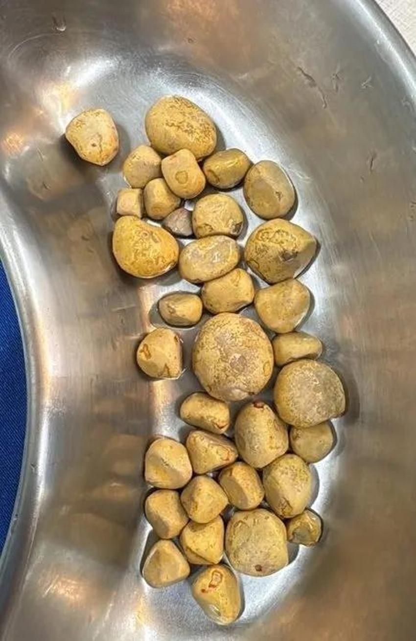 Belirtisi kötü oldu! Günde 3 litre kola içenin böbreklerin çıkanlara kimse inanamadı
