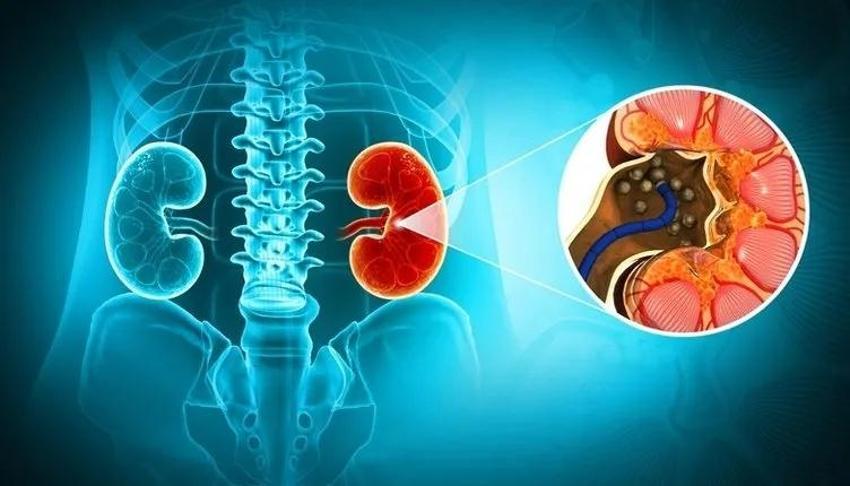 Belirtisi kötü oldu! Günde 3 litre kola içenin böbreklerin çıkanlara kimse inanamadı
