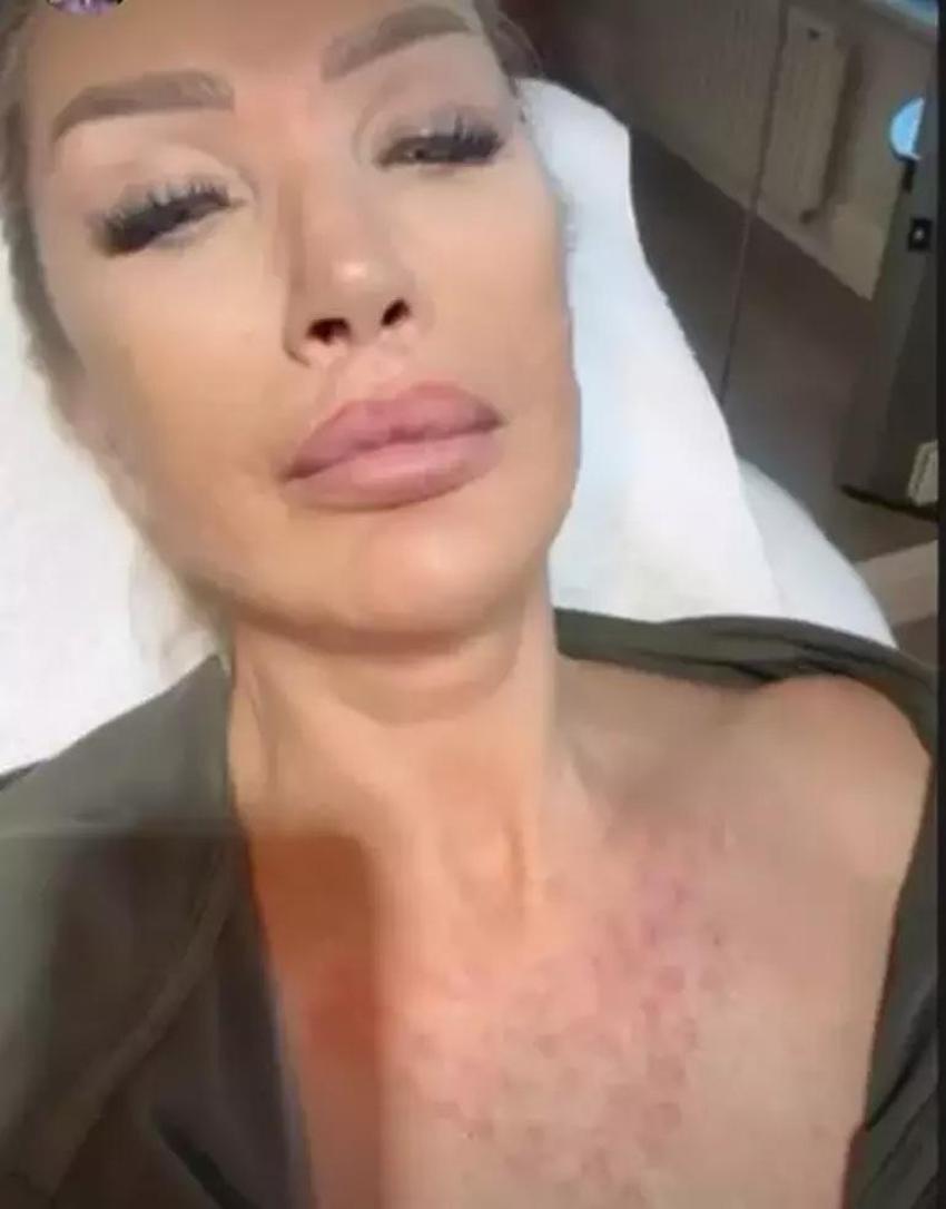 Estetik ameliyatı 9 saat süren Gülşah Saraçoğlu son halini paylaştı!