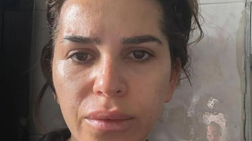 Güzel görünmek uğruna kabusu yaşadı: Basit bir iğne olduğunu düşündüm, yüzümü felç etti