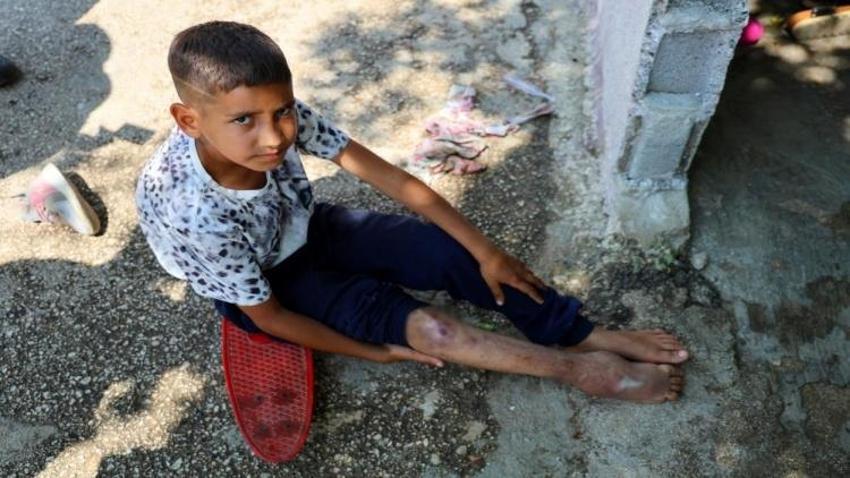 Adana'da bu da var: Baba kaçtı, anne hapiste! 11 yaşında tek ayakla yaşıyor