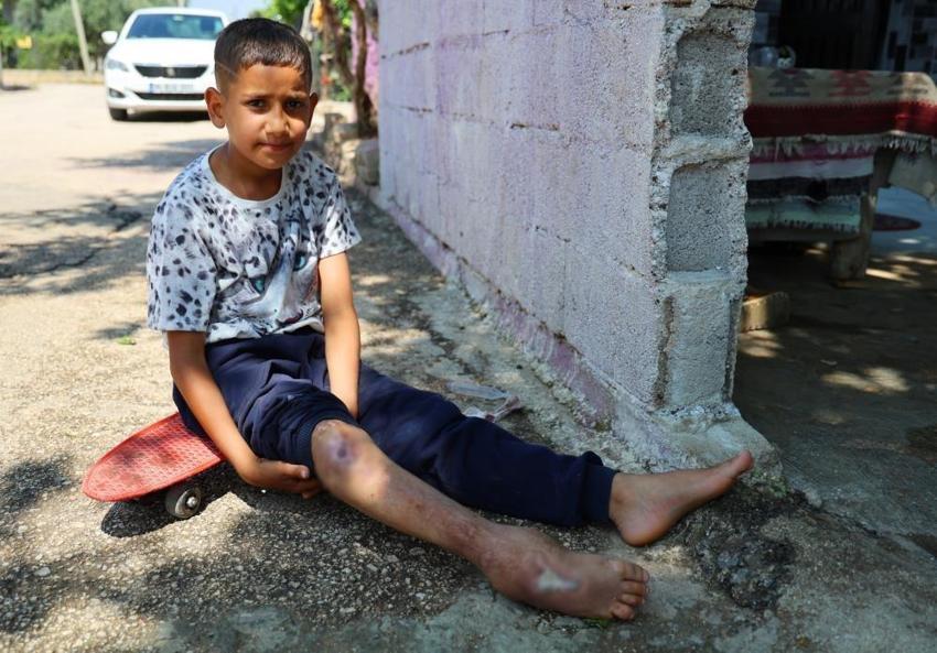 Adana'da bu da var: Baba kaçtı, anne hapiste! 11 yaşında tek ayakla yaşıyor