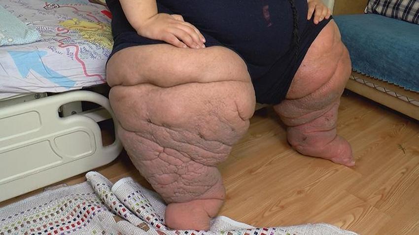 270 kilo olan Mehmet, tedavisi için yardım istiyor: 15 aydır bu odaya kilitlenip kaldım, kurtulmak istiyorum