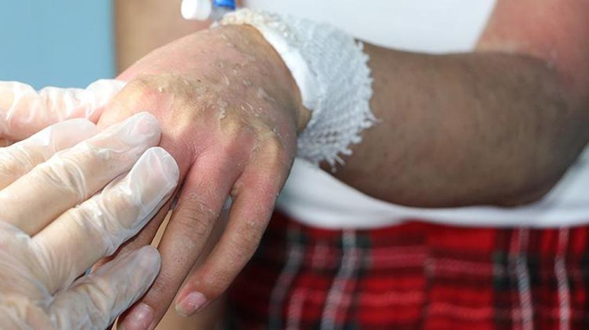 Van'da genç kadının hayatını kabusa çeviren krem! İnternetten sipariş etti hastanelik oldu: 'Kezzap gibi bir ürün'