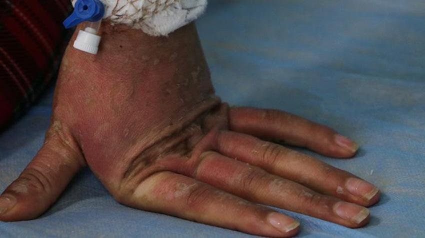 Van'da genç kadının hayatını kabusa çeviren krem! İnternetten sipariş etti hastanelik oldu: 'Kezzap gibi bir ürün'