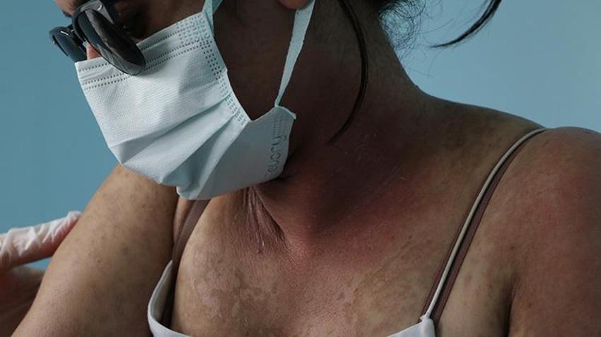 Van'da genç kadının hayatını kabusa çeviren krem! İnternetten sipariş etti hastanelik oldu: 'Kezzap gibi bir ürün'