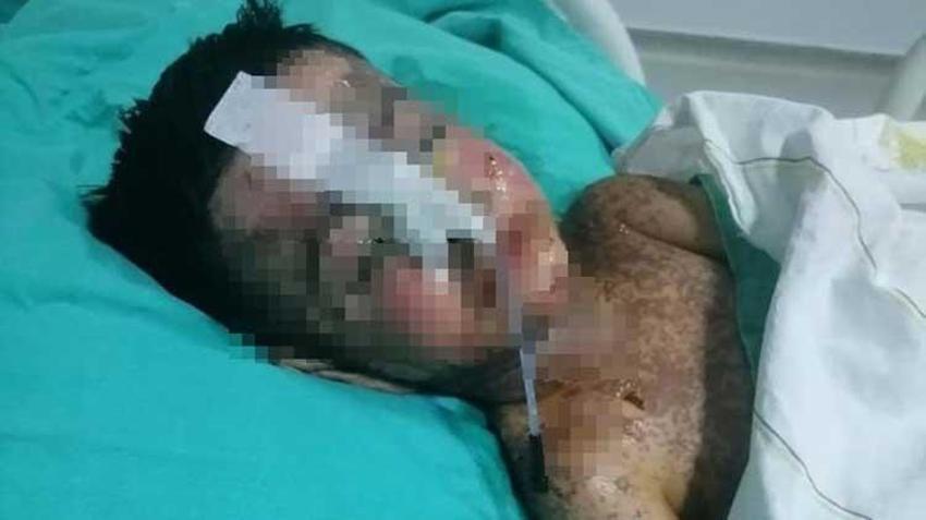 Salatalık yutunca rahatsızlandı, 3 yıl önce vücudunda tel unutulduğu ortaya çıktı! 'Kalbine ve ciğerlerine zarar vermiş'
