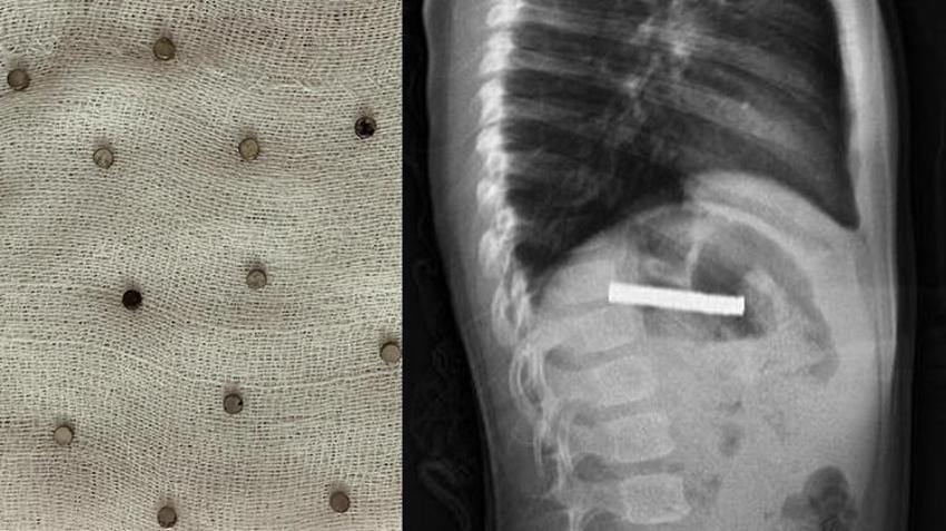 Erzurum'da 3 yaşındaki çocuğun yuttuğu 19 mıknatıs Elazığ'da endoskopiyle çıkarıldı