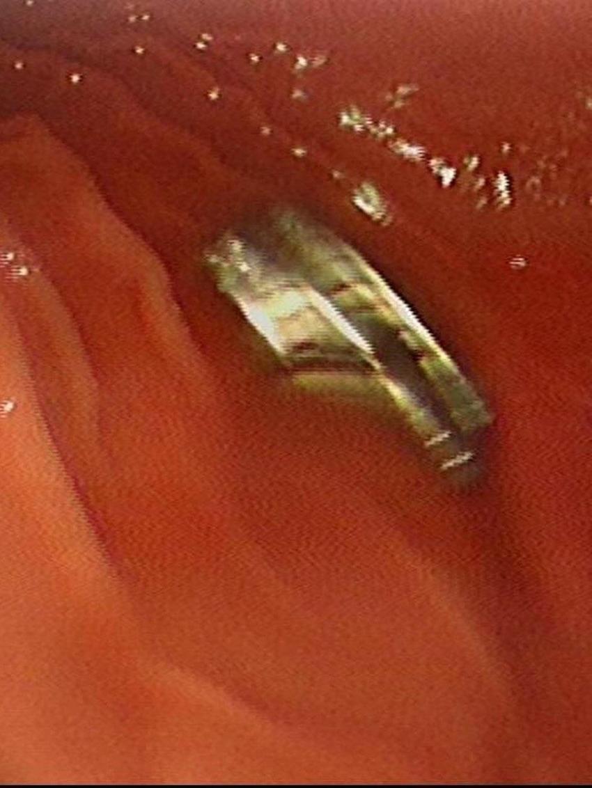 Erzurum'da 3 yaşındaki çocuğun yuttuğu 19 mıknatıs Elazığ'da endoskopiyle çıkarıldı