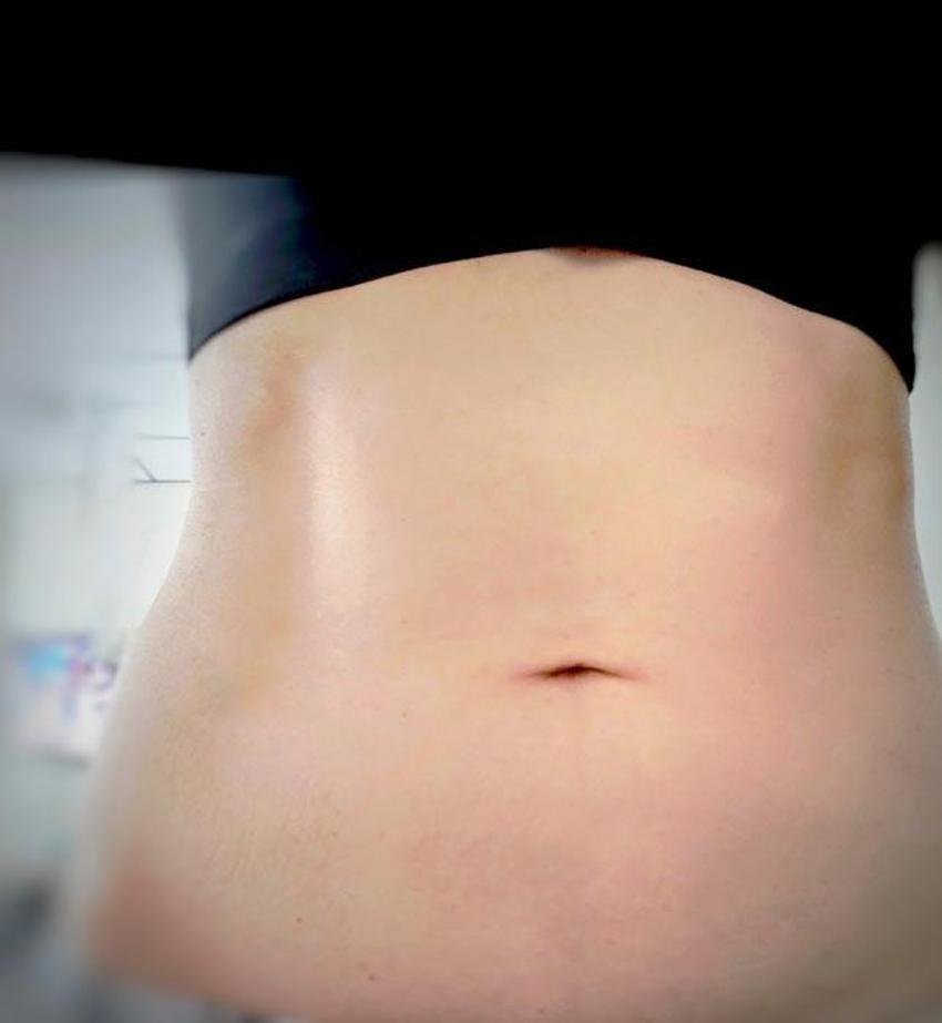 Lipödem hastalığında yaşın11’e kadar düştü! Diyetle tamamen yok olmuyor, uzman isim çaresini açıkladı