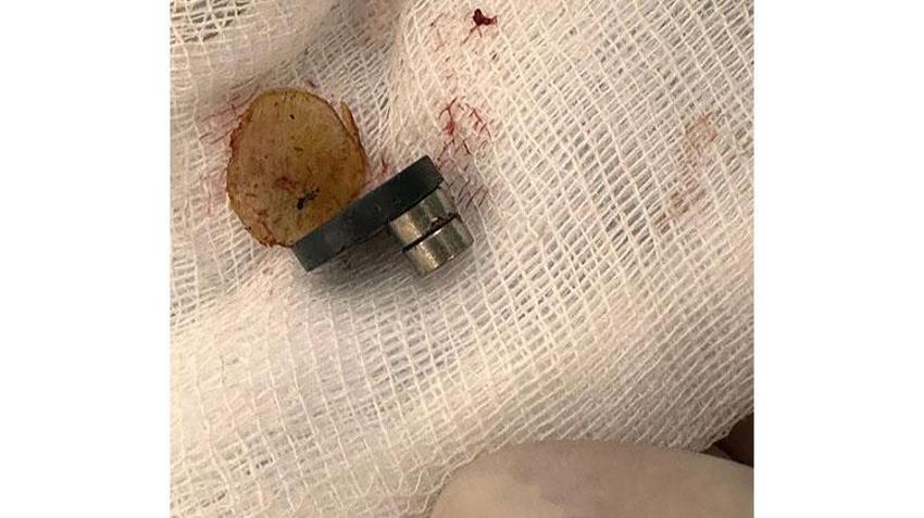 Batman'da karın ağrısı şikayetiyle hastaneye götürülen çocuğun bağırsaklarından çıkanlar şoke etti
