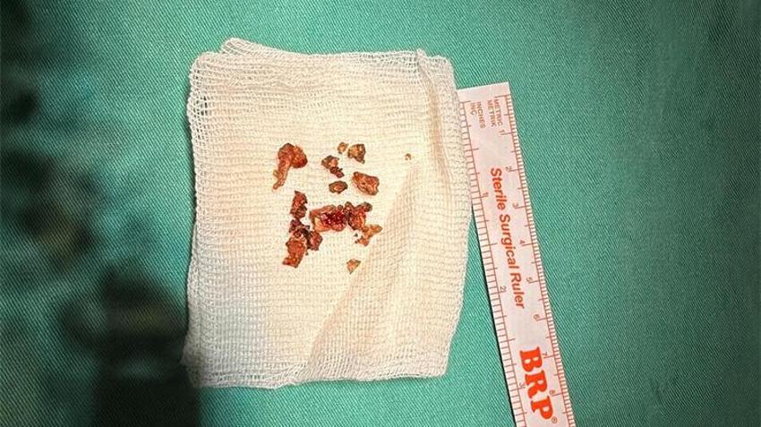 Elazığ’da ameliyat oldu, burnundan çıkanlar şoke etti