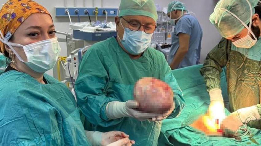 Amasya'da hastaneye gitti, doktorlar dondu kaldı: Karnından 6 kilo çıkardılar