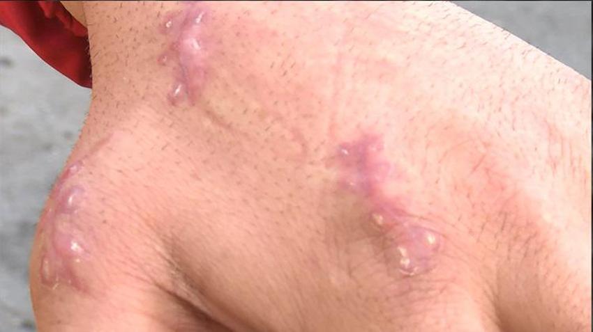 Kedisi tarafından ısırılan vatandaş antibiyotik verilerek gönderildi! Enfeksiyon kapan parmağı kopma noktasına geldi
