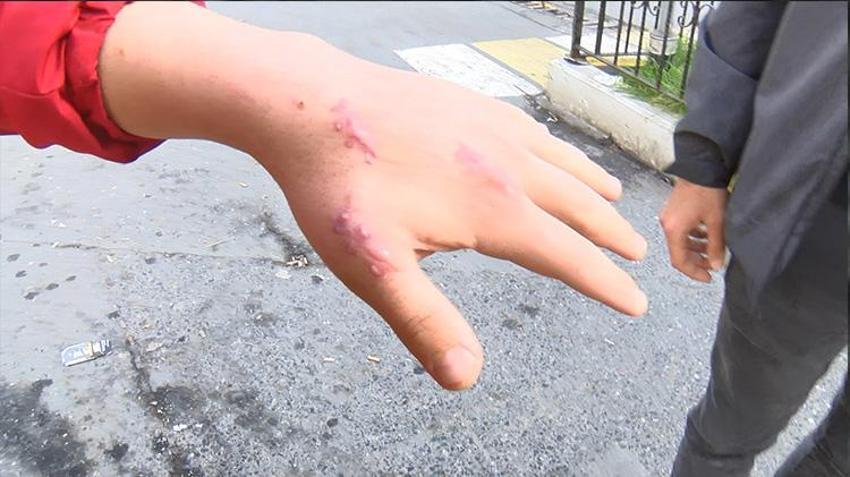 Kedisi tarafından ısırılan vatandaş antibiyotik verilerek gönderildi! Enfeksiyon kapan parmağı kopma noktasına geldi