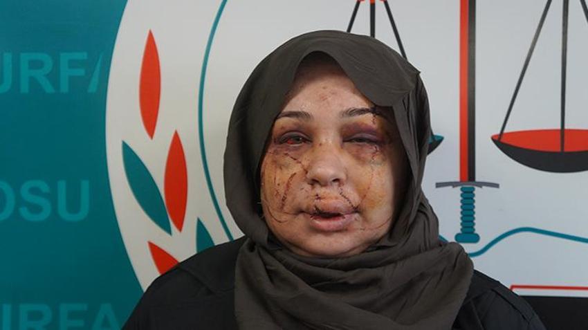 Eşinden şiddet gören kadının yüzü tanınmaz hale geldi! 'Vicdanı olan herkesten yardım istiyorum'