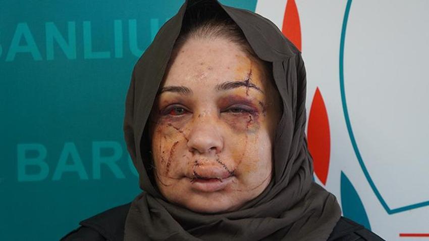 Eşinden şiddet gören kadının yüzü tanınmaz hale geldi! 'Vicdanı olan herkesten yardım istiyorum'