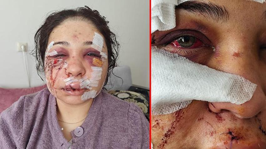 Eşinden şiddet gören kadının yüzü tanınmaz hale geldi! 'Vicdanı olan herkesten yardım istiyorum'
