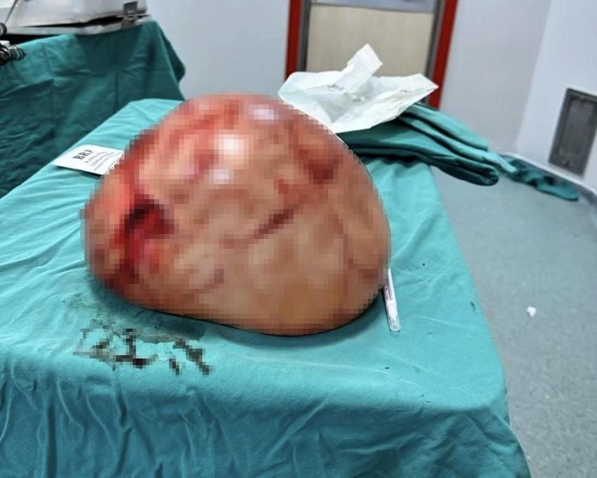 Van Yüzüncü Yıl Üniversitesi'nde bir kadının karnından 35 santimetrelik dev kitle çıkarıldı