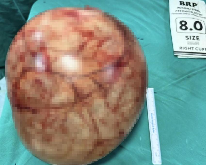 Van Yüzüncü Yıl Üniversitesi'nde bir kadının karnından 35 santimetrelik dev kitle çıkarıldı