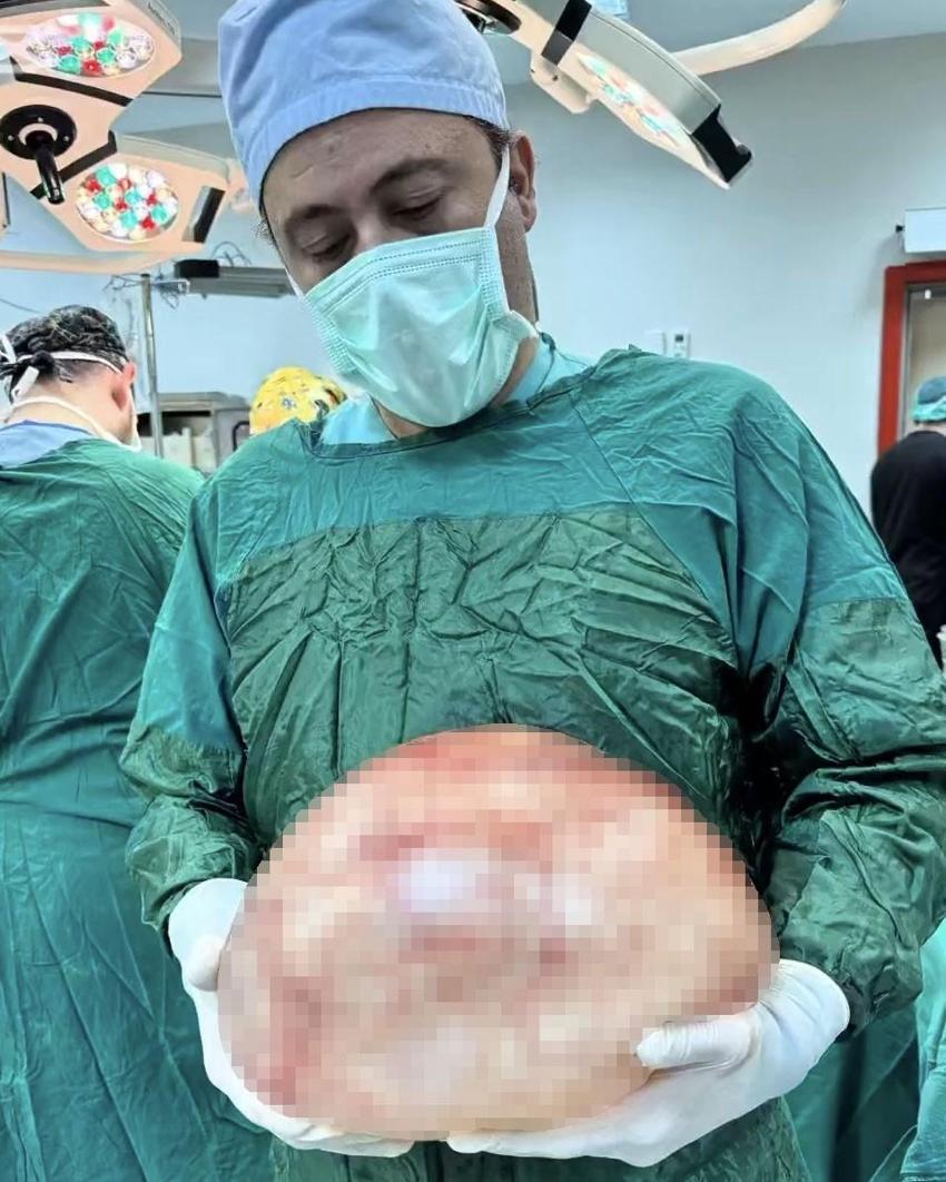 Van Yüzüncü Yıl Üniversitesi'nde bir kadının karnından 35 santimetrelik dev kitle çıkarıldı