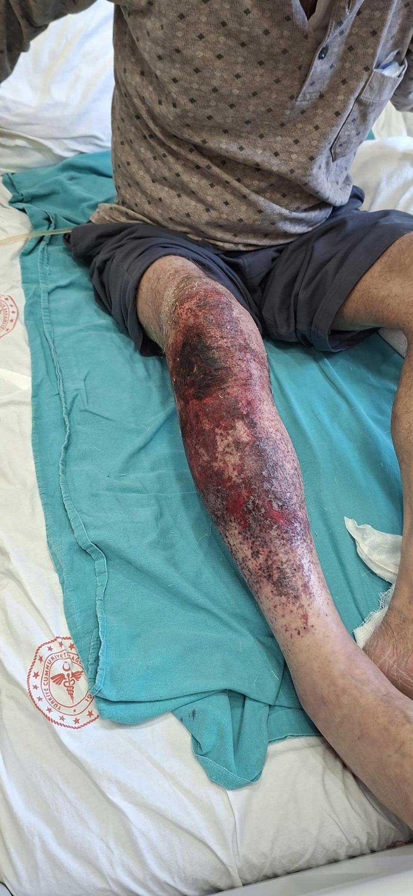 Lavabo açarken hastanelik oldu: 79 yaşındaki Halis Amca’nın acı tecrübesi: Bir paket döktü, hayatı karardı