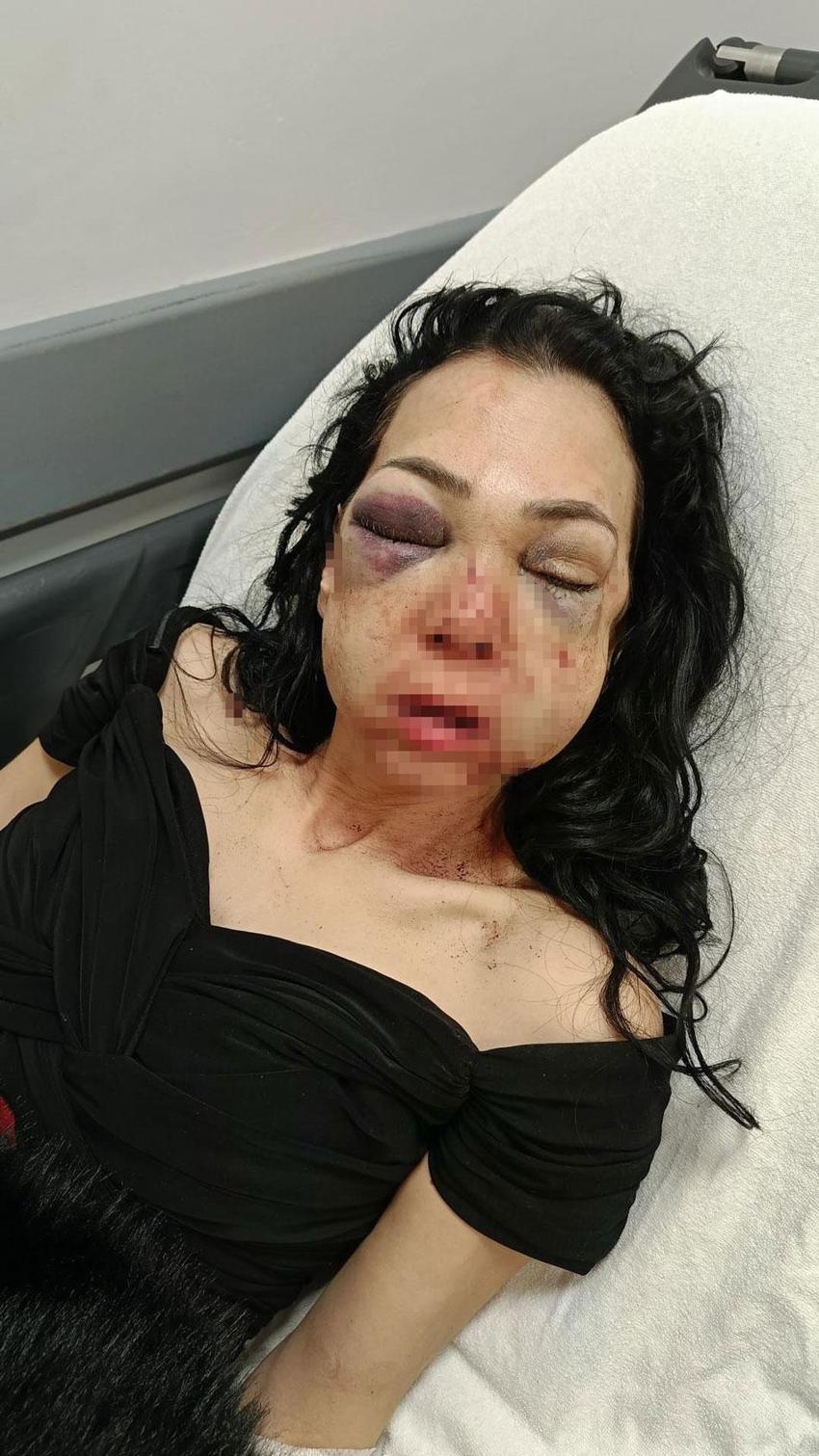 Bayramda 'küfretmeyin' diye uyaran anne ve oğlunu feci şekilde darp etmişlerdi; Meryem Yıldırım yaşadığı dehşeti unutamıyor
