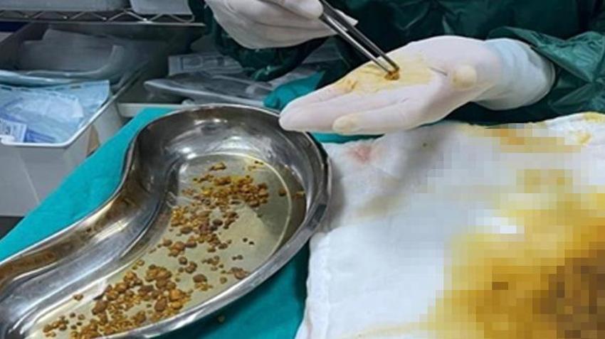 Karın ağrısı şikayetiyle gitti, gerçek hastanede ortaya çıktı! Doktorlar şaşkına döndü