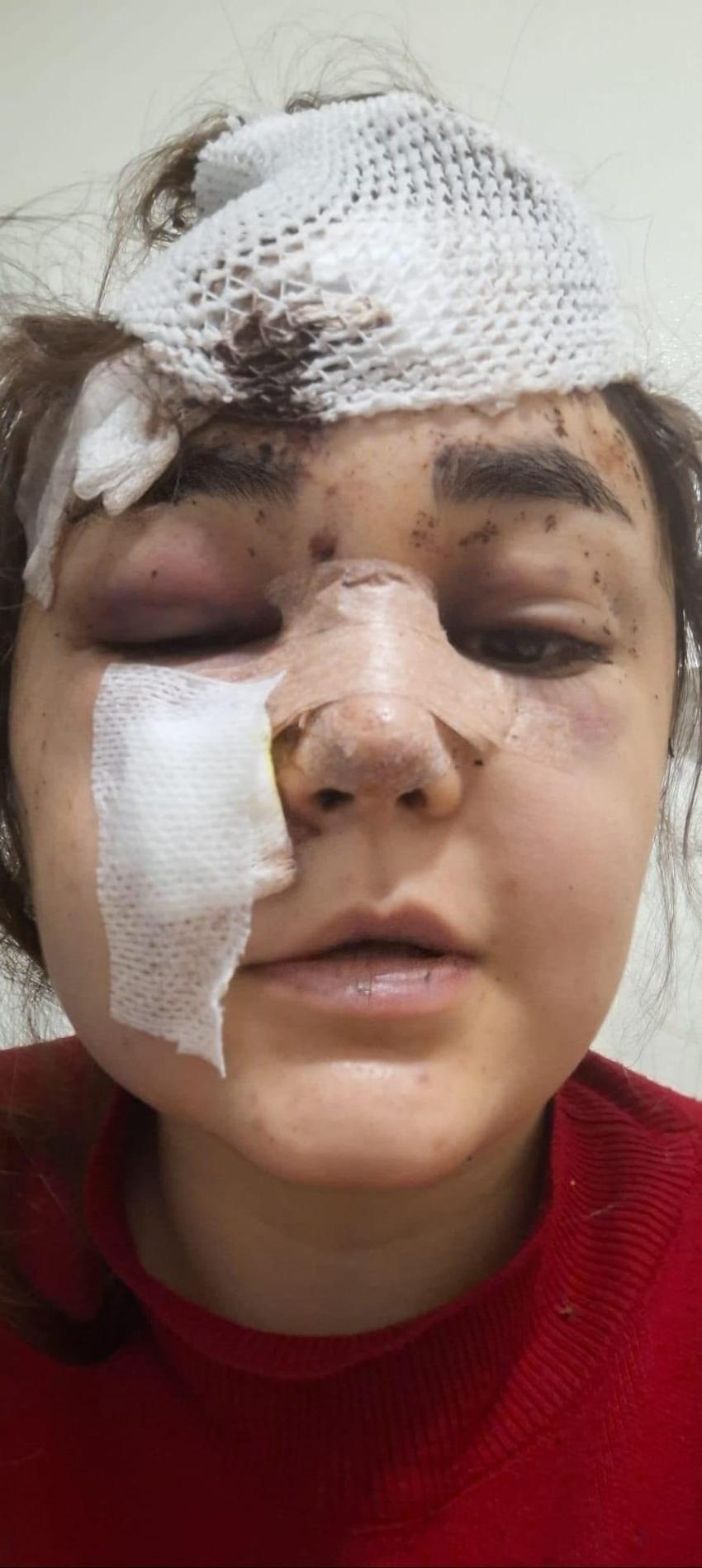 Gaziantep'te boşanma aşamasındaki eşinin yüzünü tanınmaz hale getirdi! Savcı kaldırım taşını silah sayıldığını belirtti