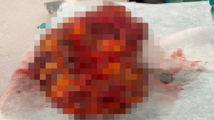 Karın ağrısı şikayetiyle hastaneye gitti! Doktorlar bile gözlerine inanamadı: Tam 8 kilo