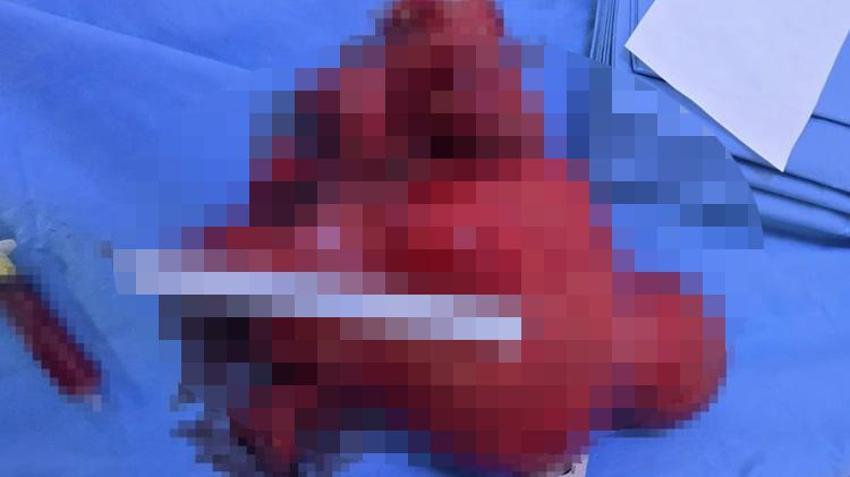 Karın ağrısı şikayetiyle hastaneye gitti, doktorlar bile şaşkına döndü! Acil ameliyatla hayata döndü
