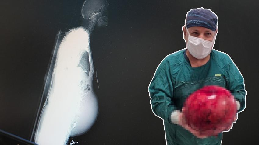 Kocaeli'de doktorlar inanamadı! Hastaneye geldi, 6,5 kilo çıktı: İlk defa bu kadar büyük gördüm