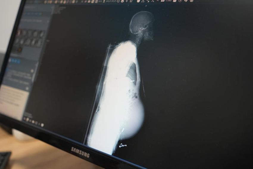 Kocaeli'de doktorlar inanamadı! Hastaneye geldi, 6,5 kilo çıktı: İlk defa bu kadar büyük gördüm