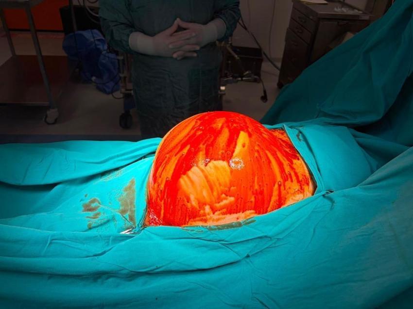 Kocaeli'de doktorlar inanamadı! Hastaneye geldi, 6,5 kilo çıktı: İlk defa bu kadar büyük gördüm