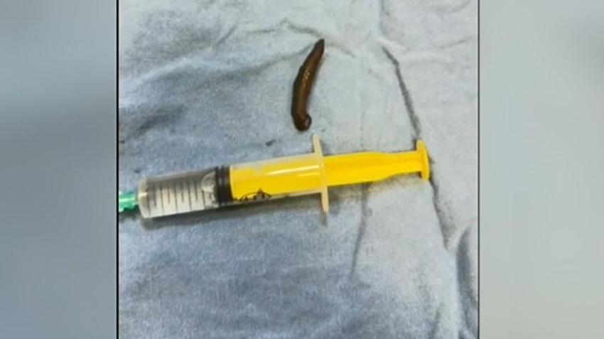 Doktorlar bile şaşkına döndü! Çeşmeden su içti, boğazından canlı canlı çıktı